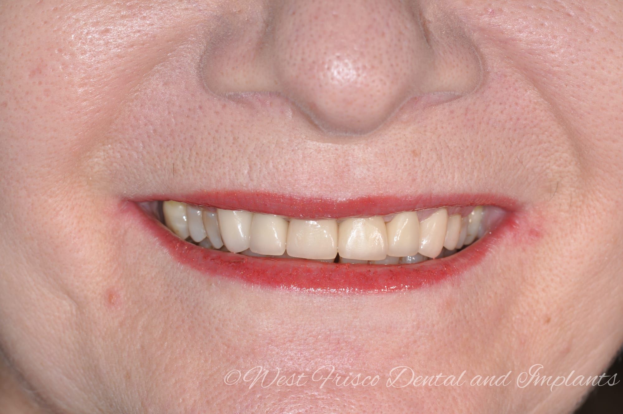 Dental crowns smile close-up - after