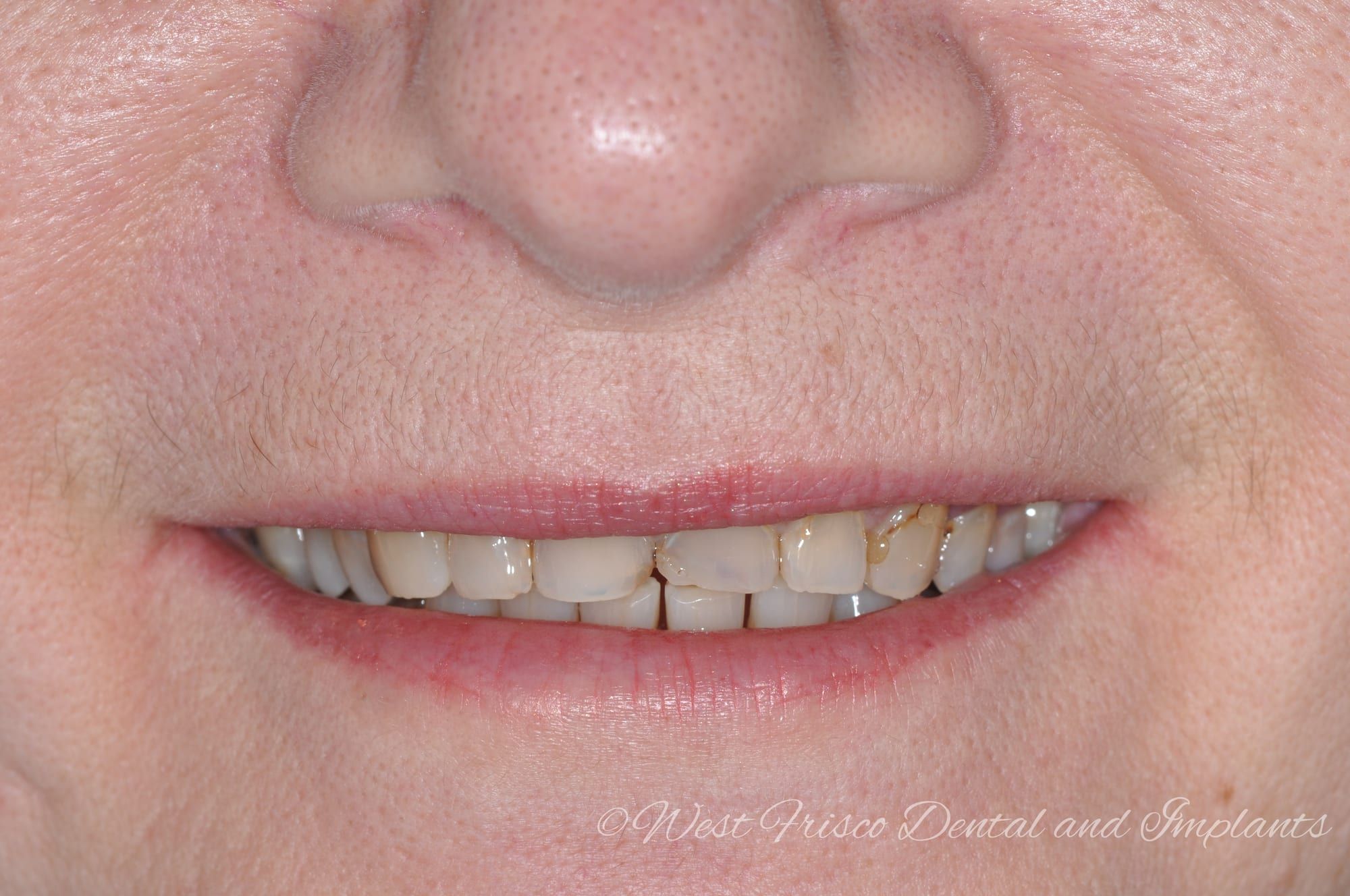 Dental crowns smile close-up - before
