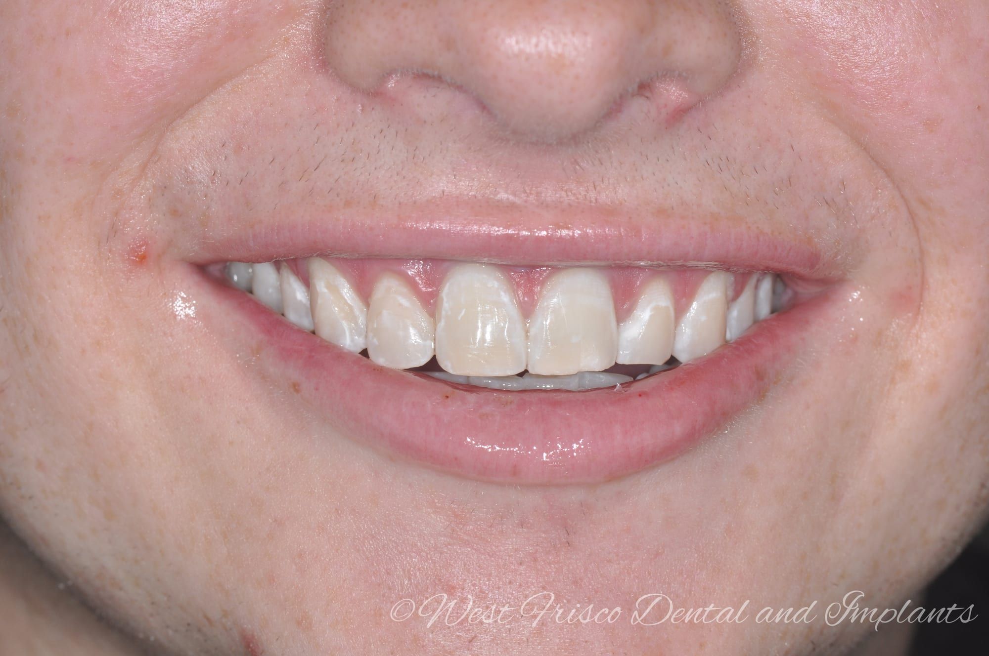 Zoom! teeth whitening - after