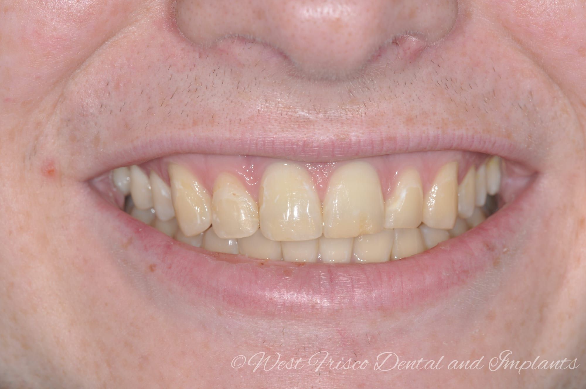 Zoom! teeth whitening - before