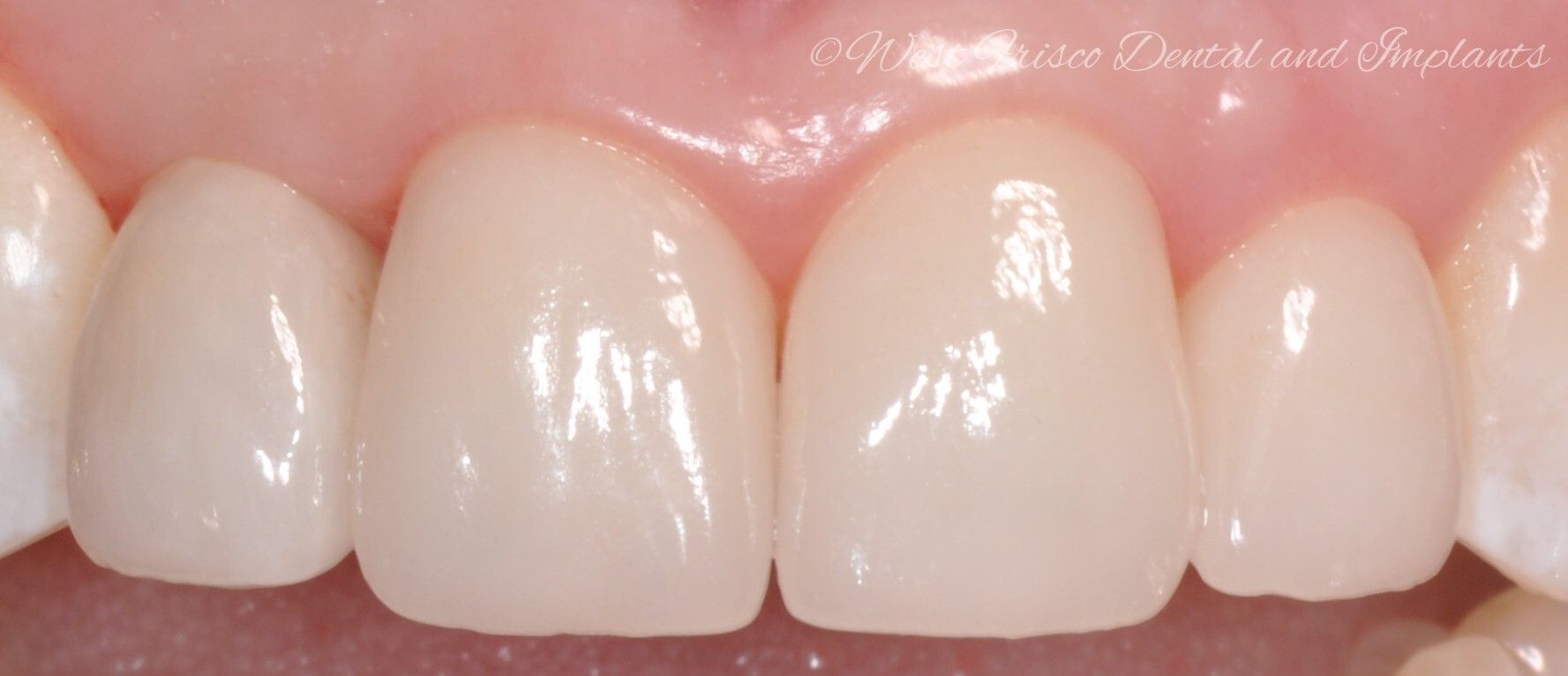 Crowns and veneers - after