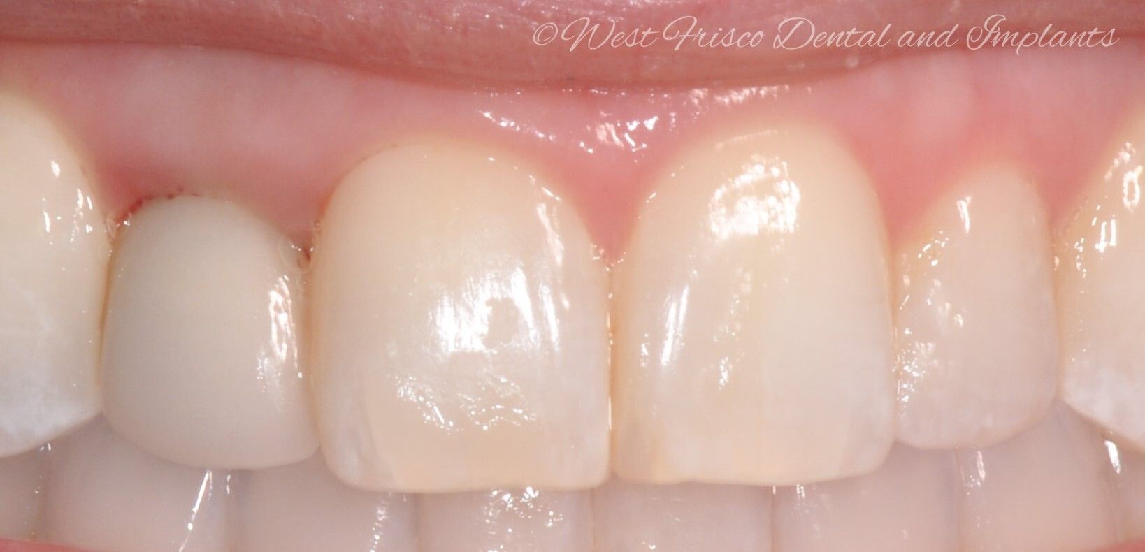 Crowns and veneers - before