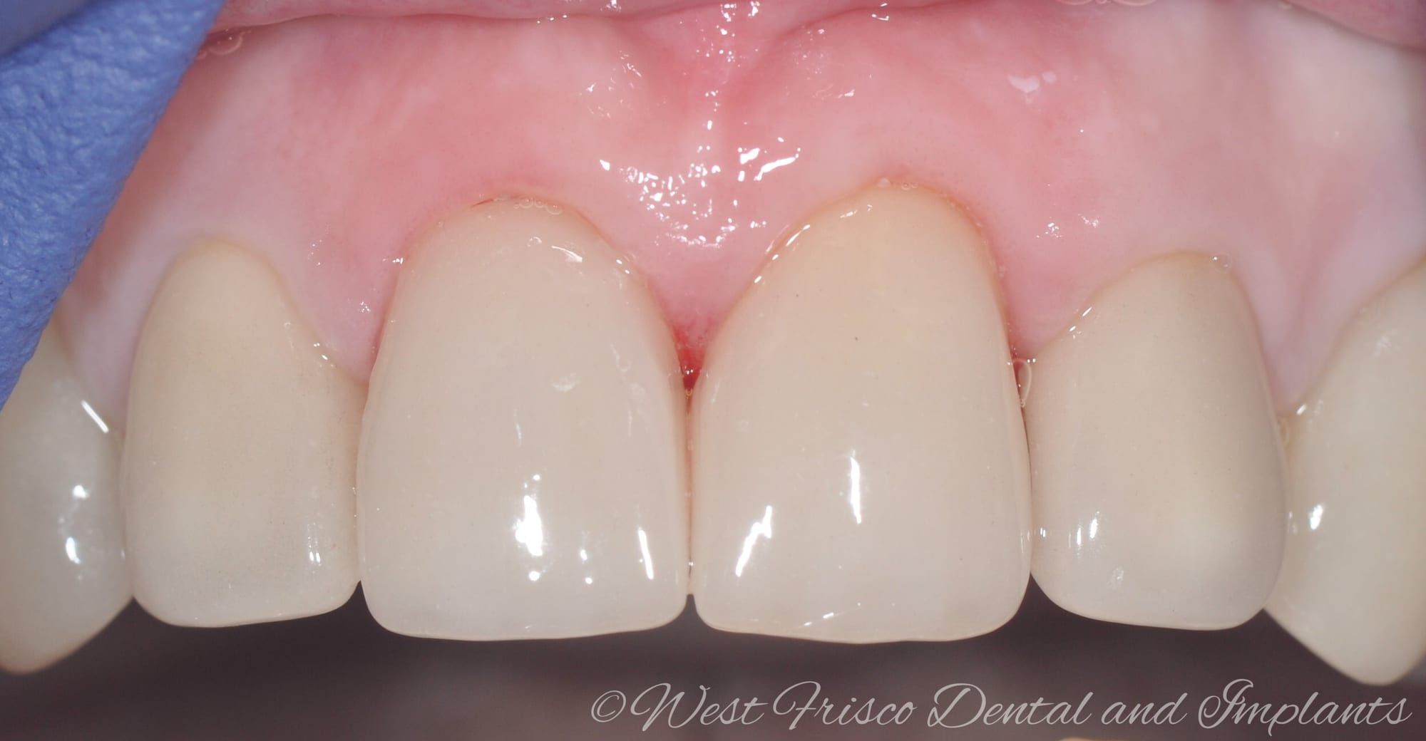 Dental crowns - after