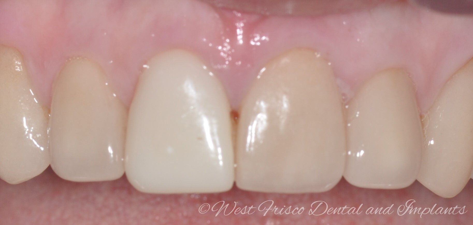 Dental crowns - before