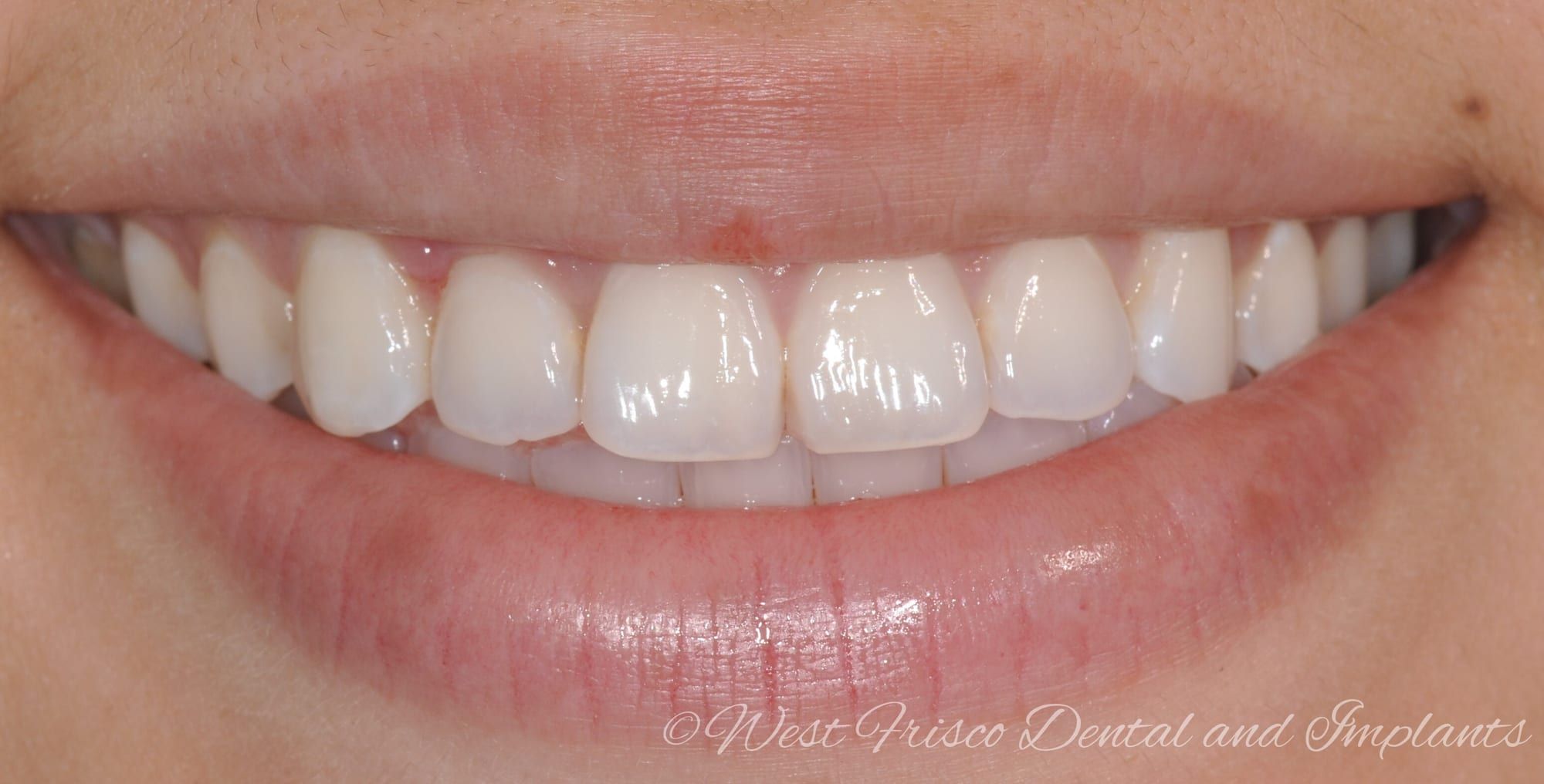 Crown lengthening (gummy smile) - after
