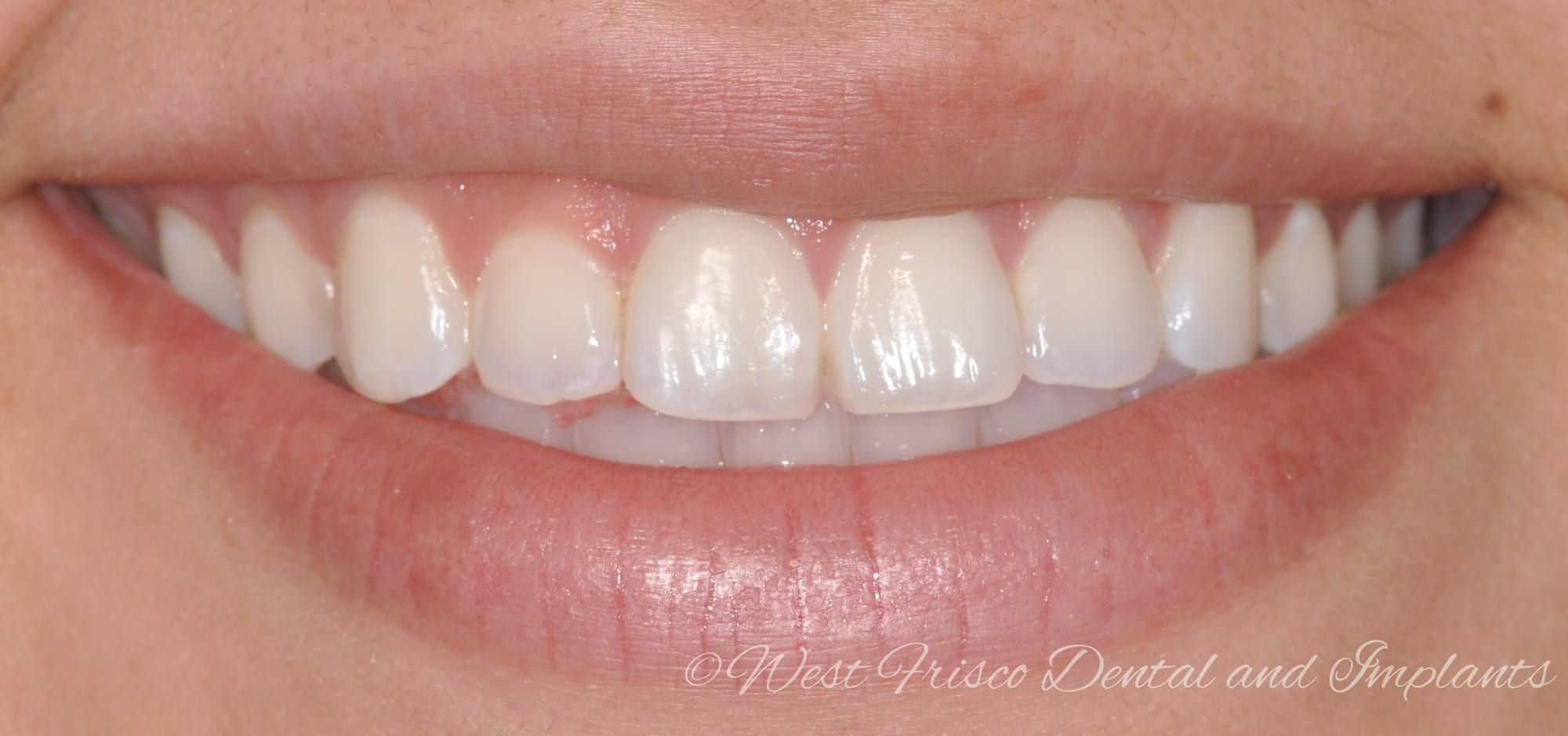 Crown lengthening (gummy smile) - before