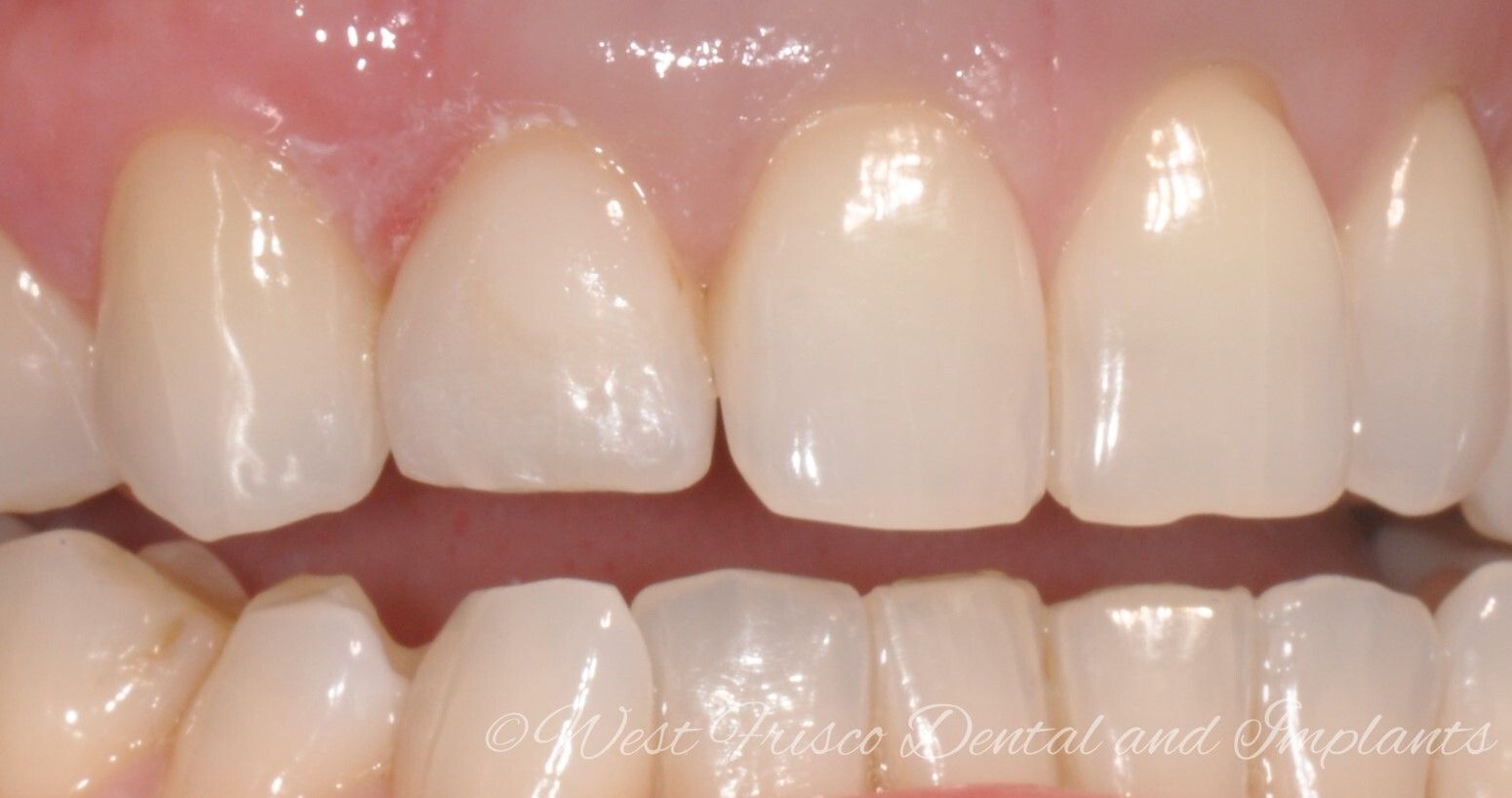 Dental bonding - after