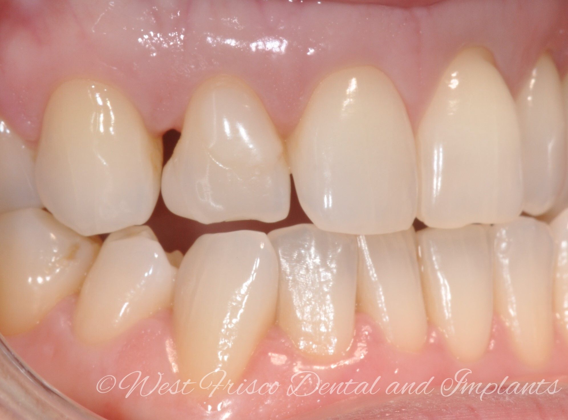 Dental bonding - before