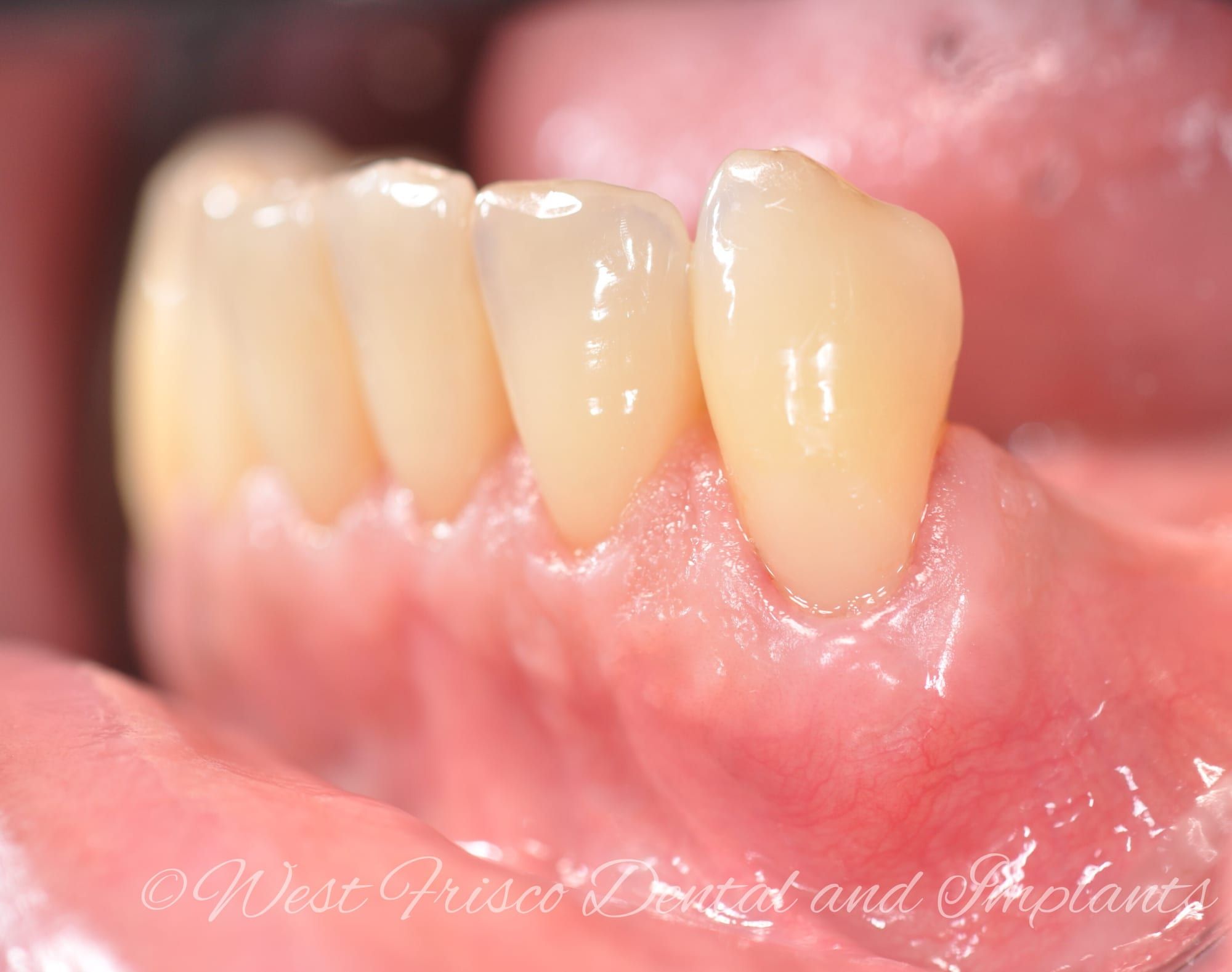 Gum grafting - after