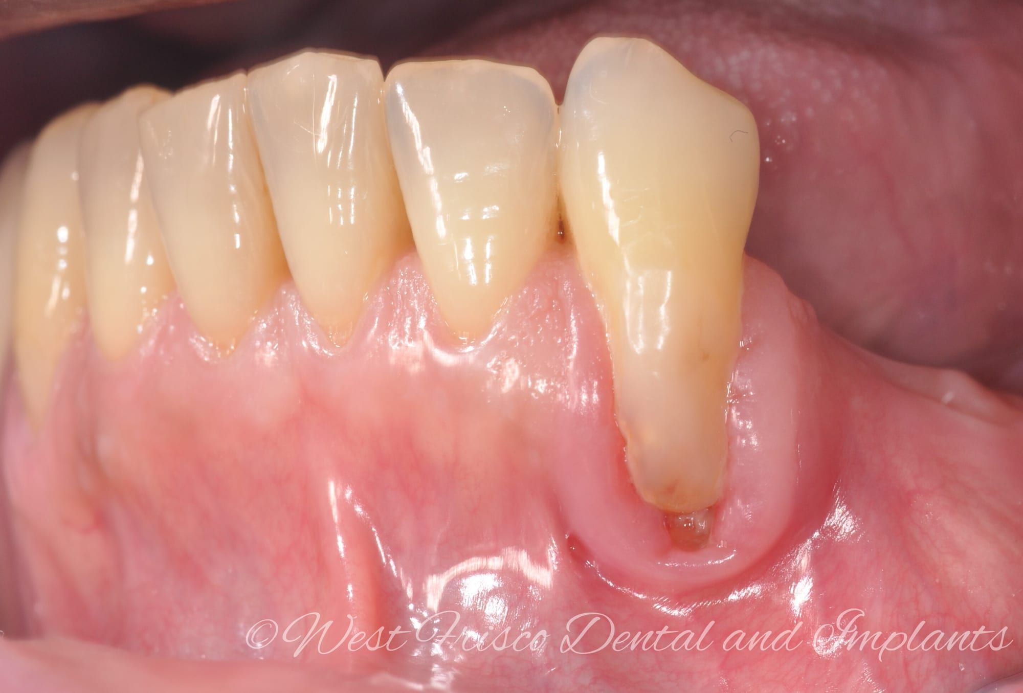 Gum grafting - before
