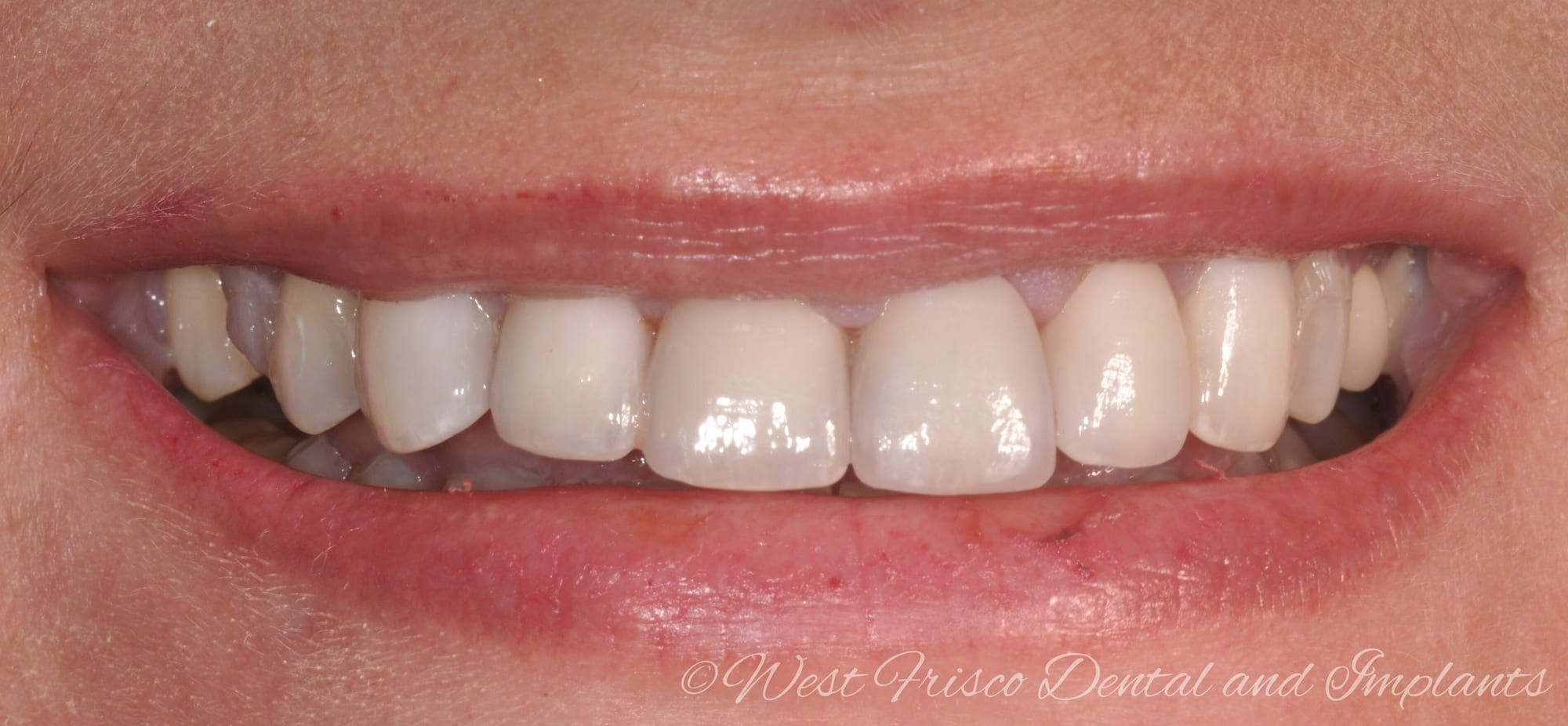 Dental crowns - after