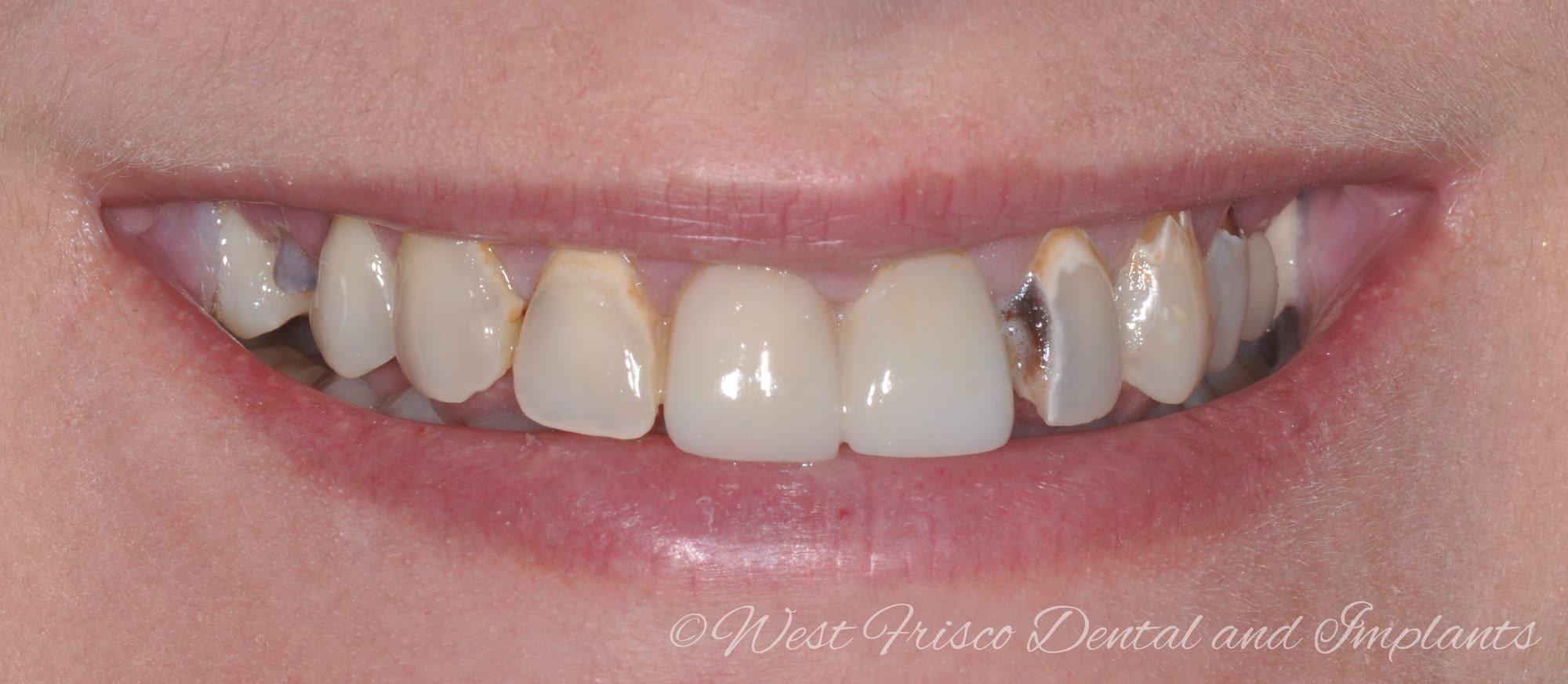 Dental crowns - before