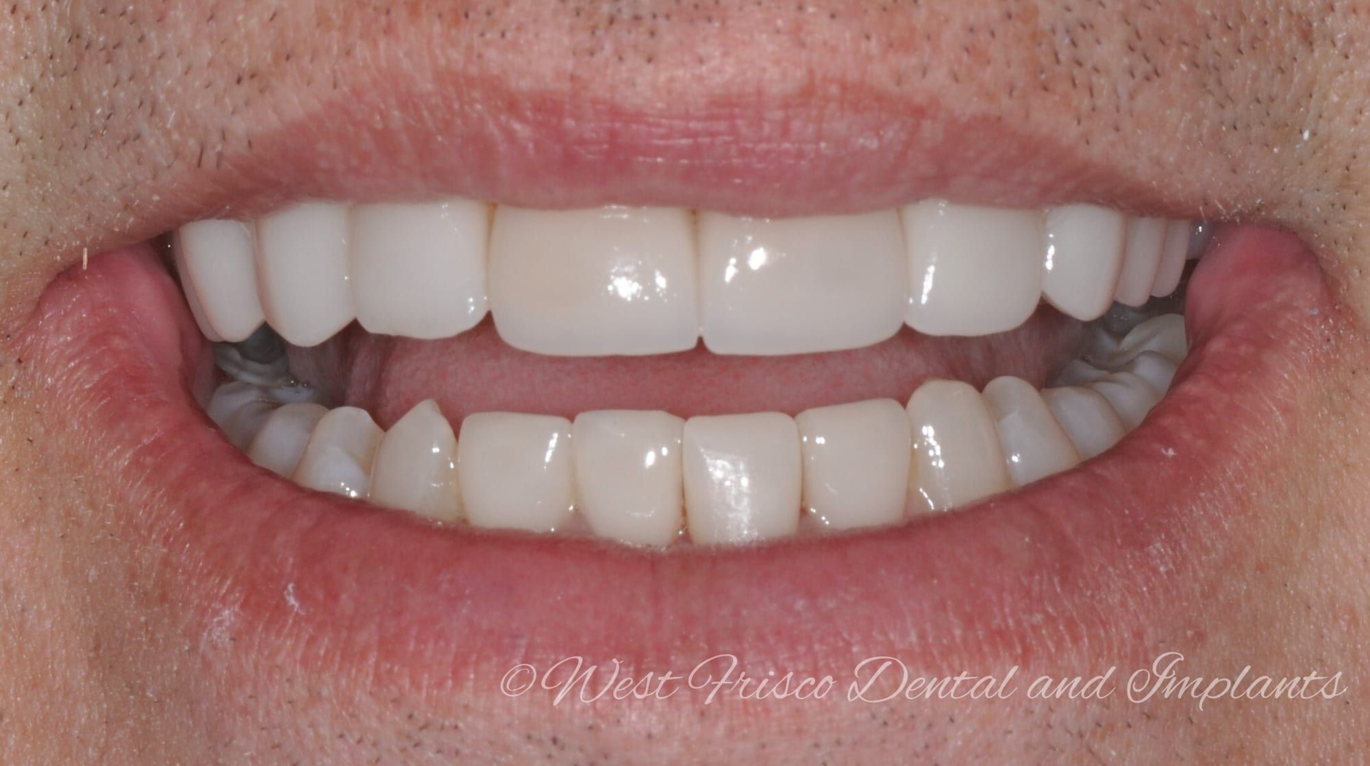 Broken veneer repair - after