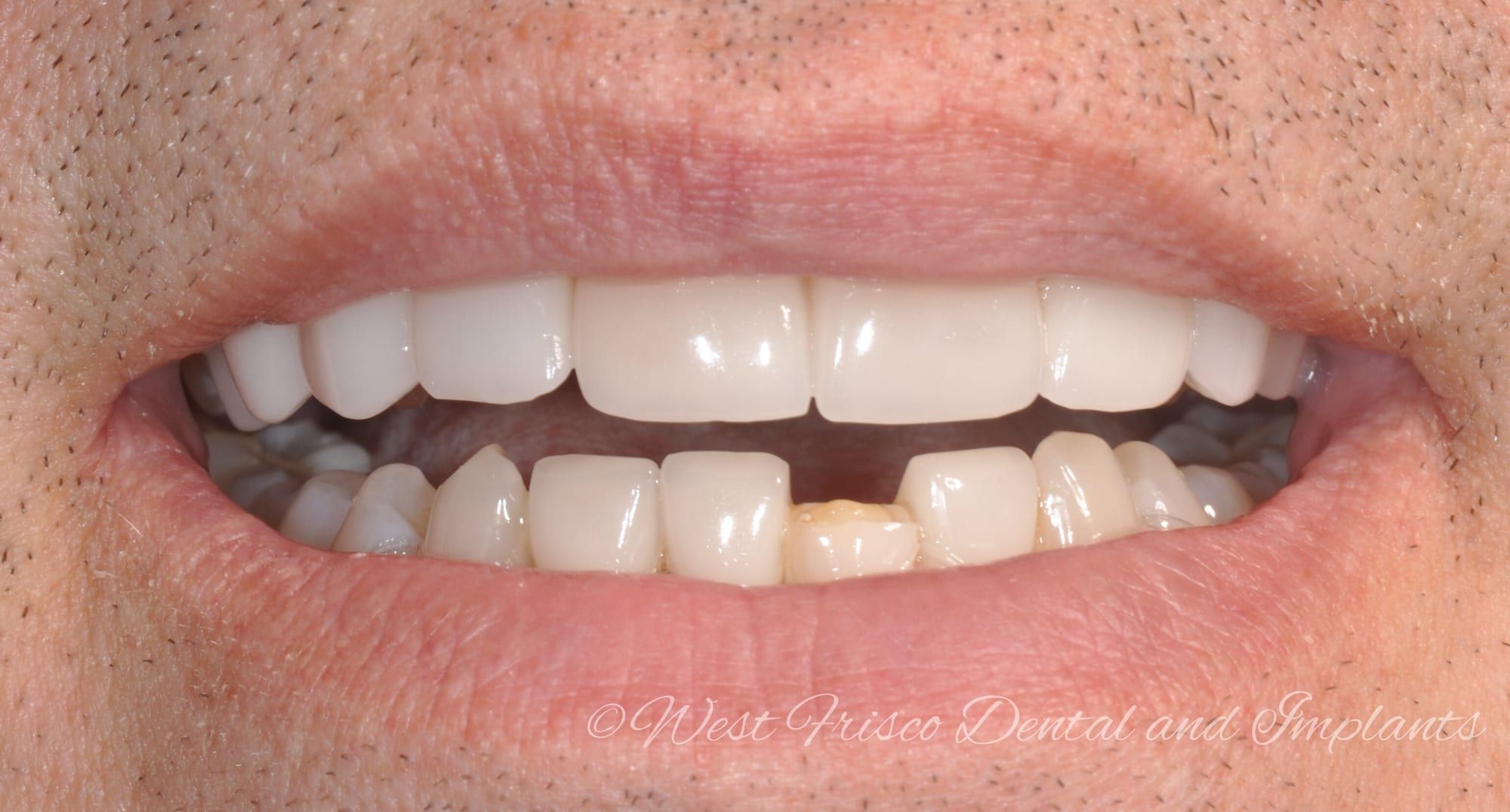 Broken veneer repair - before