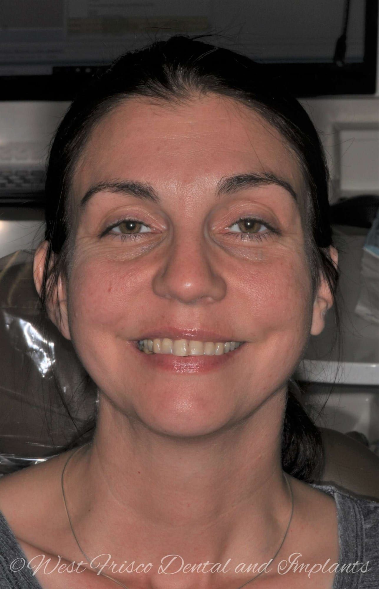 Full mouth rehabilitation - before