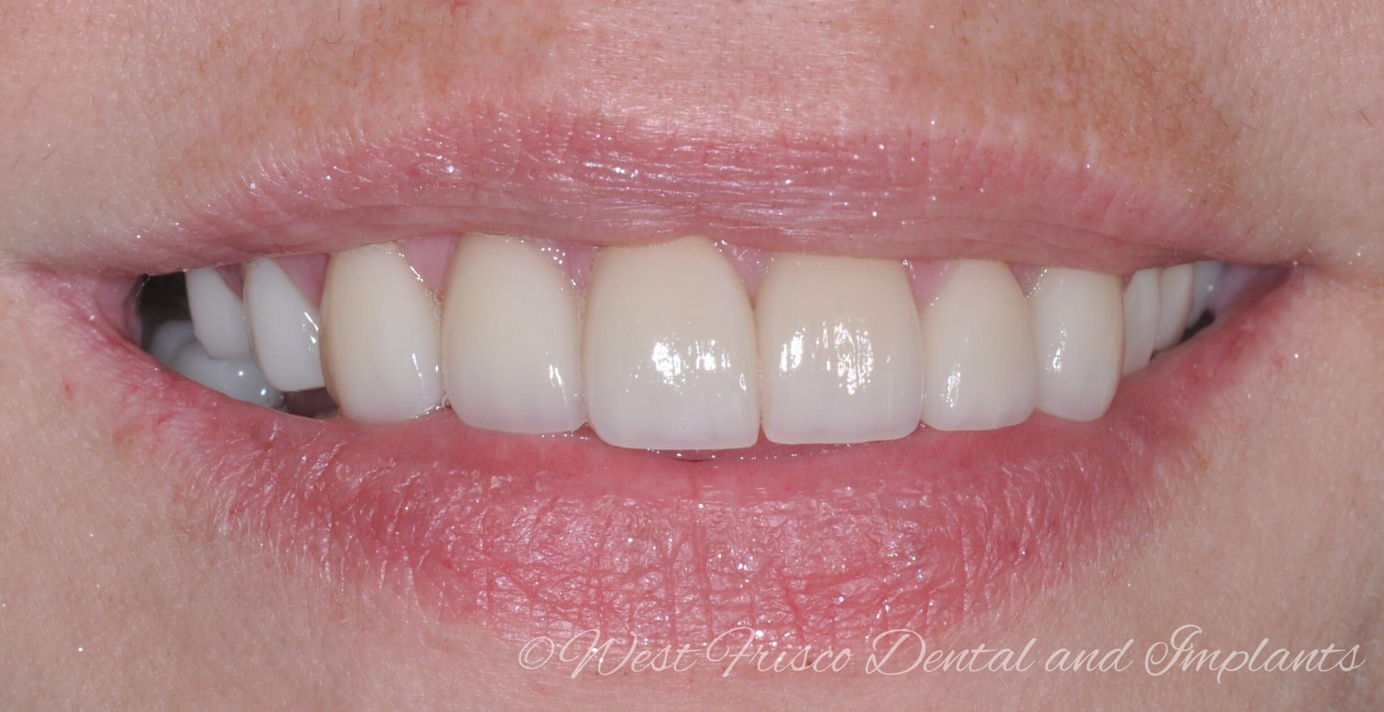 Porcelain veneers and crowns - after