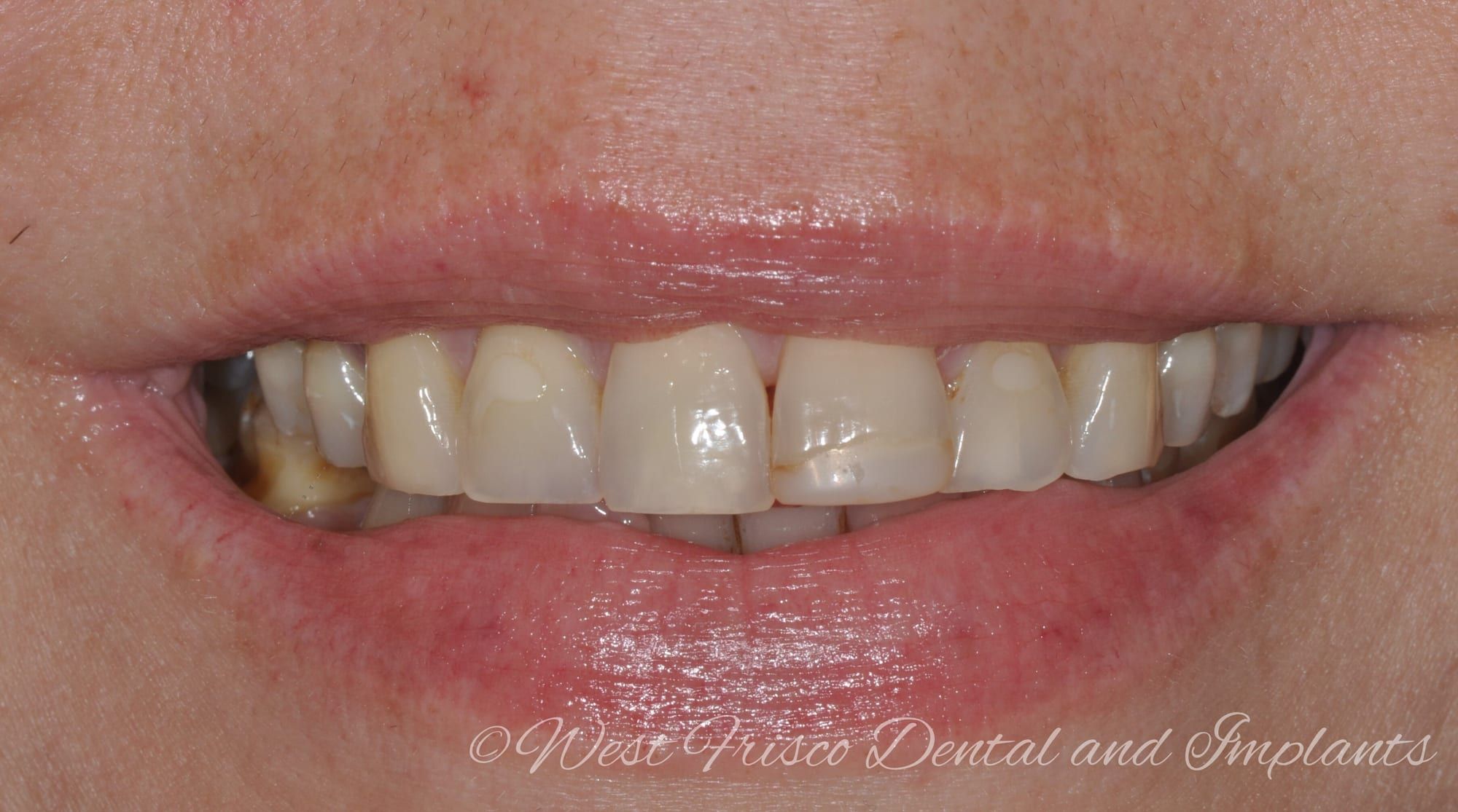 Porcelain veneers and crowns - before