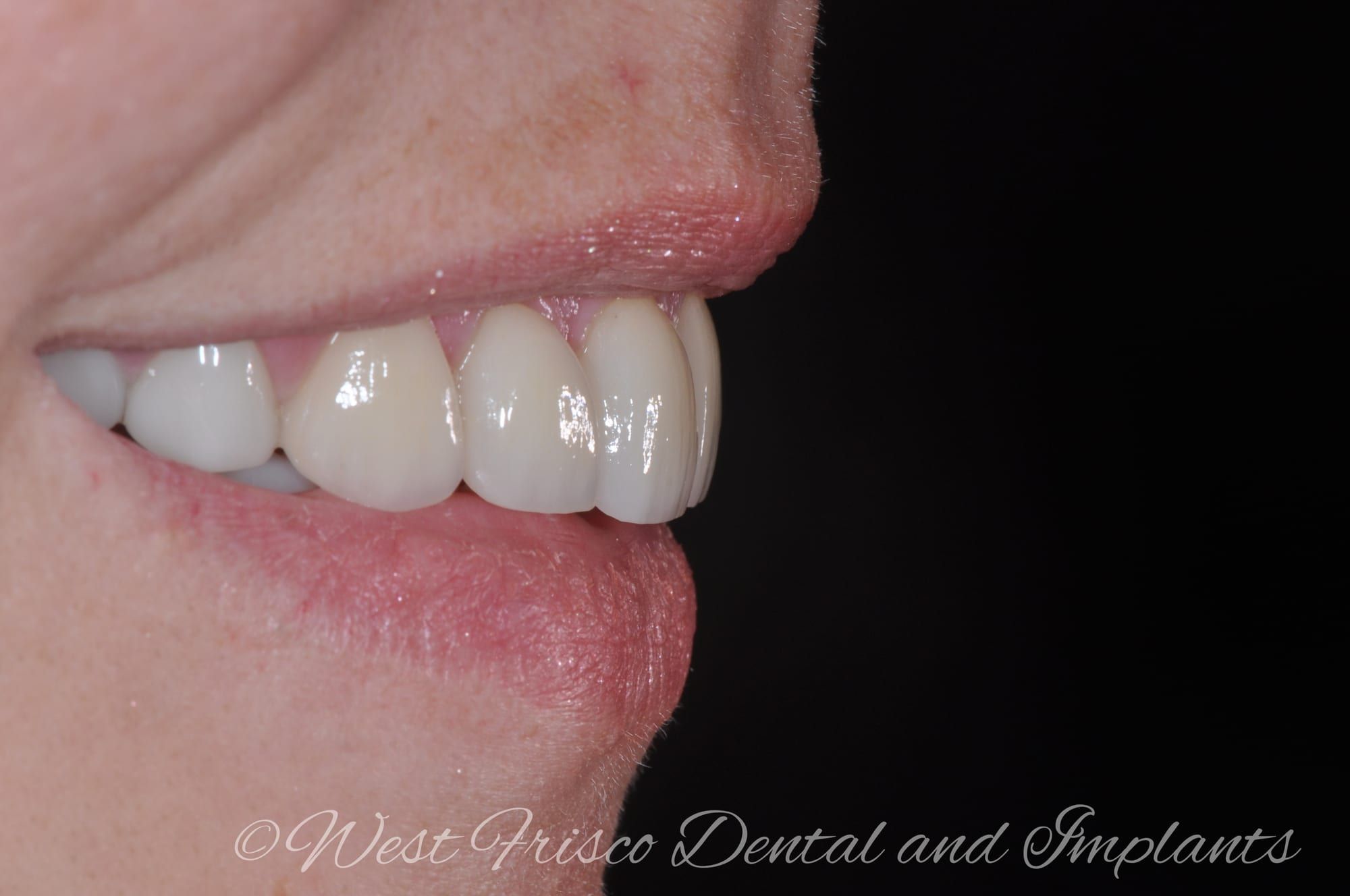 Smile makeover, profile view - after