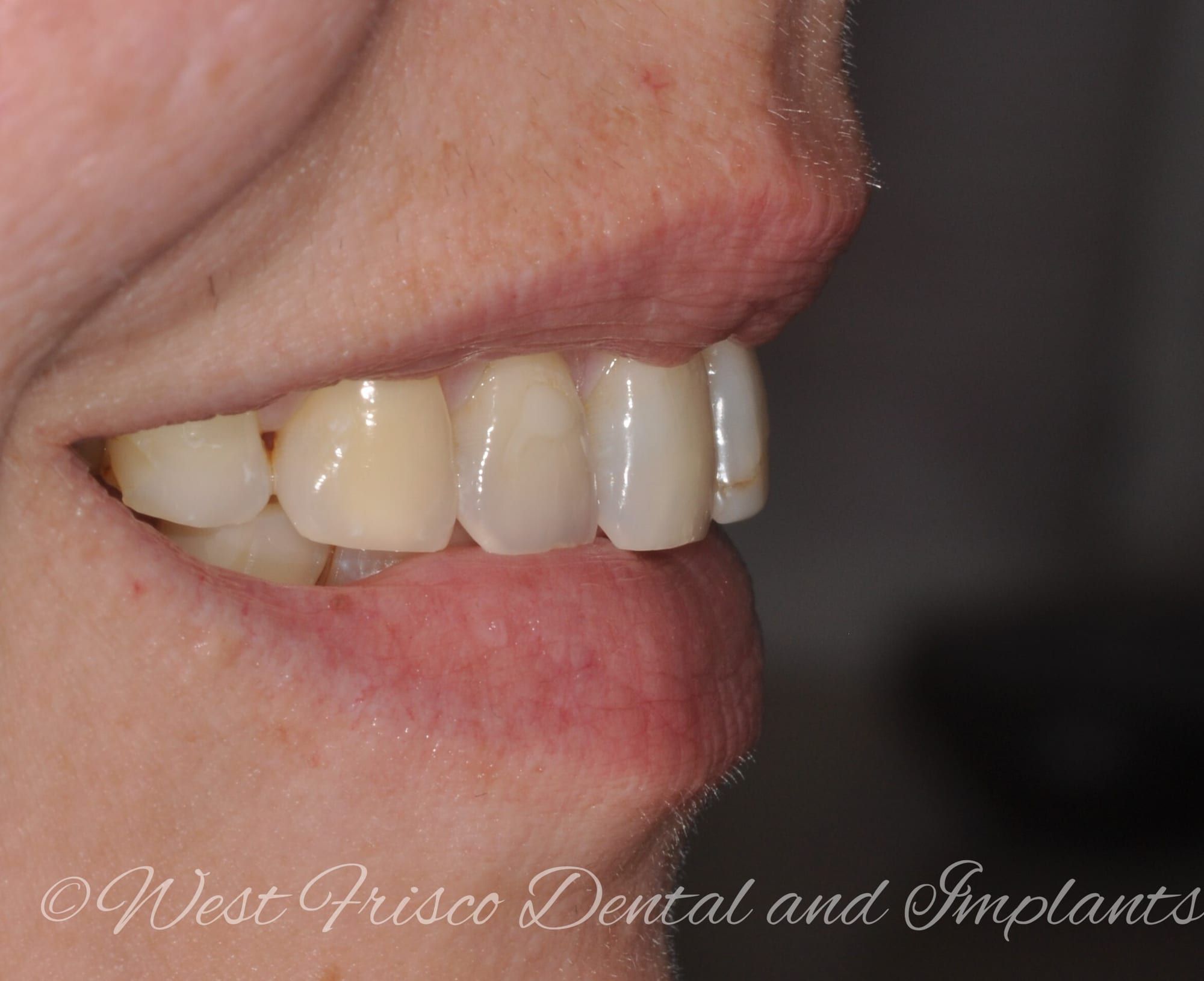 Smile makeover, profile view - before