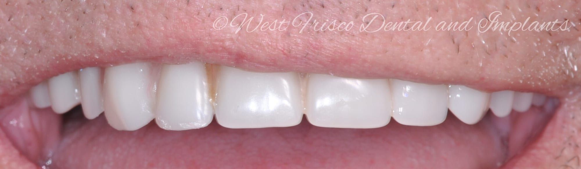 Denture repair - after