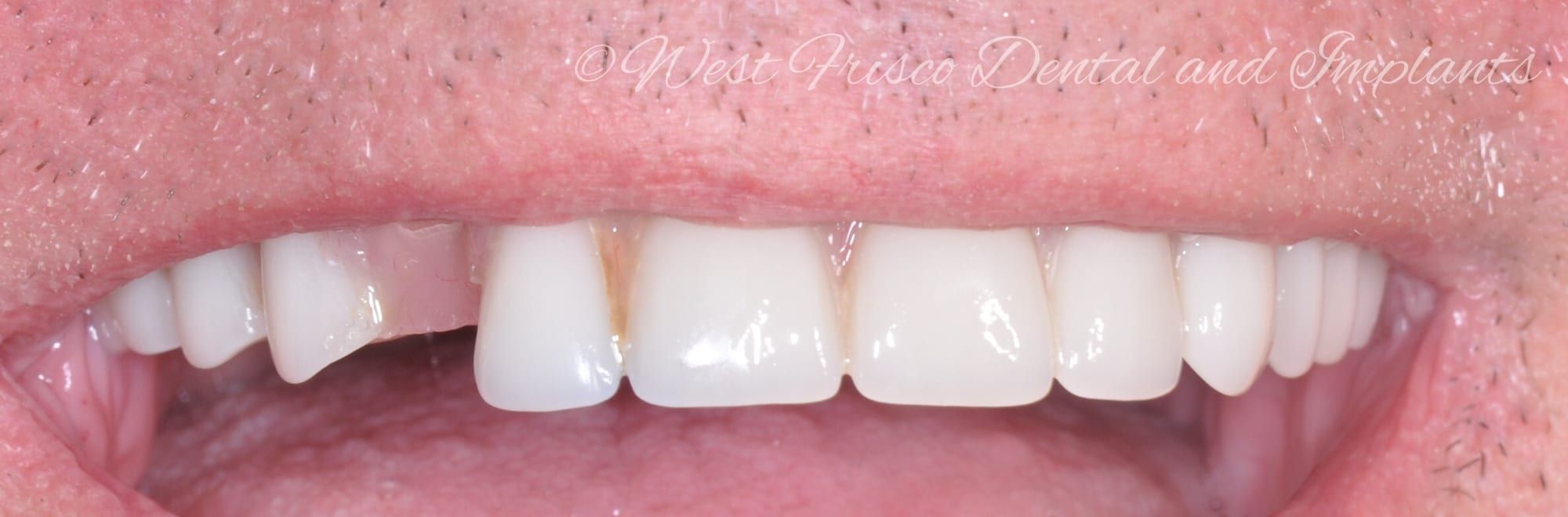 Denture repair - before