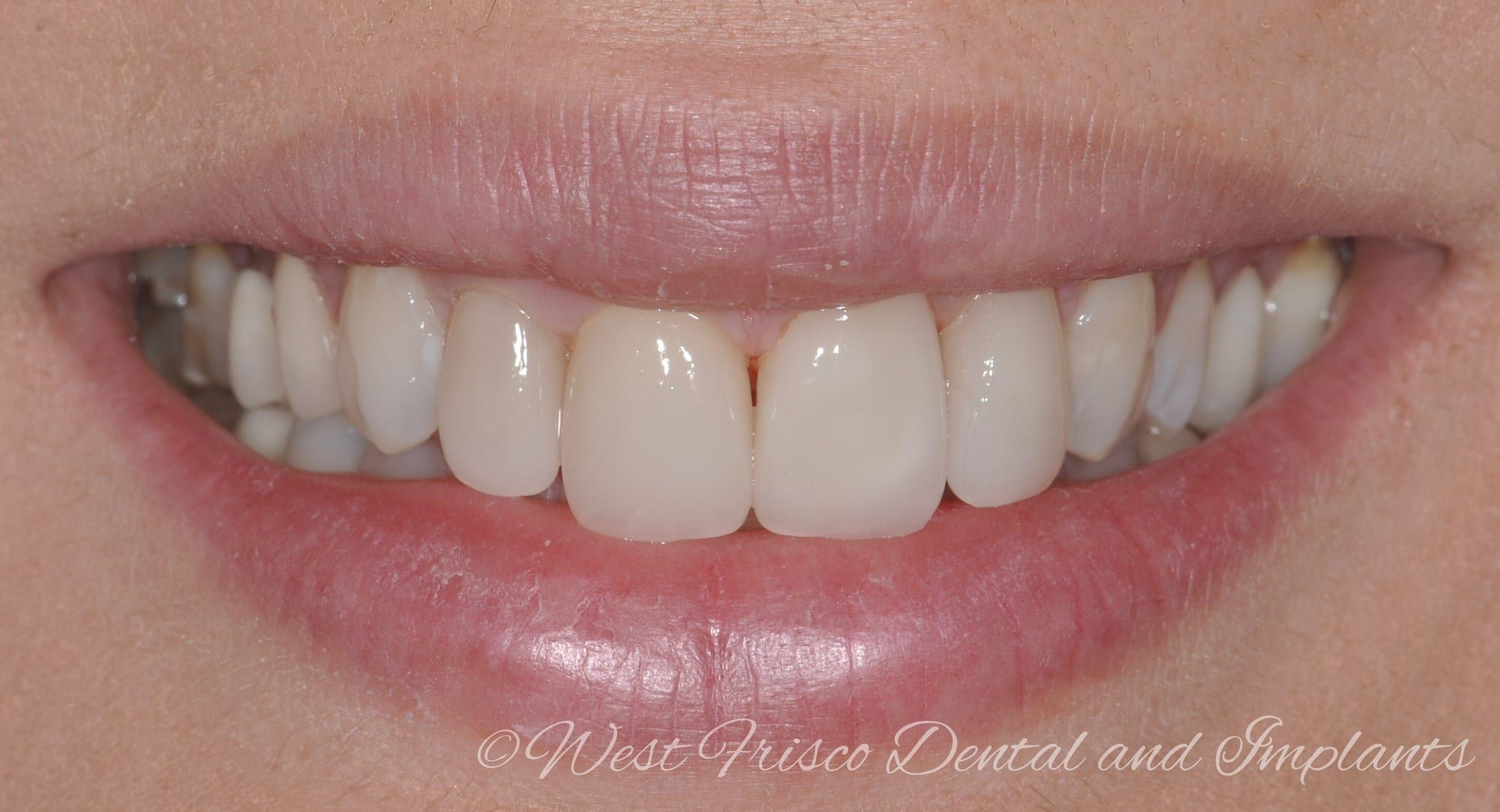Porcelain veneers - after