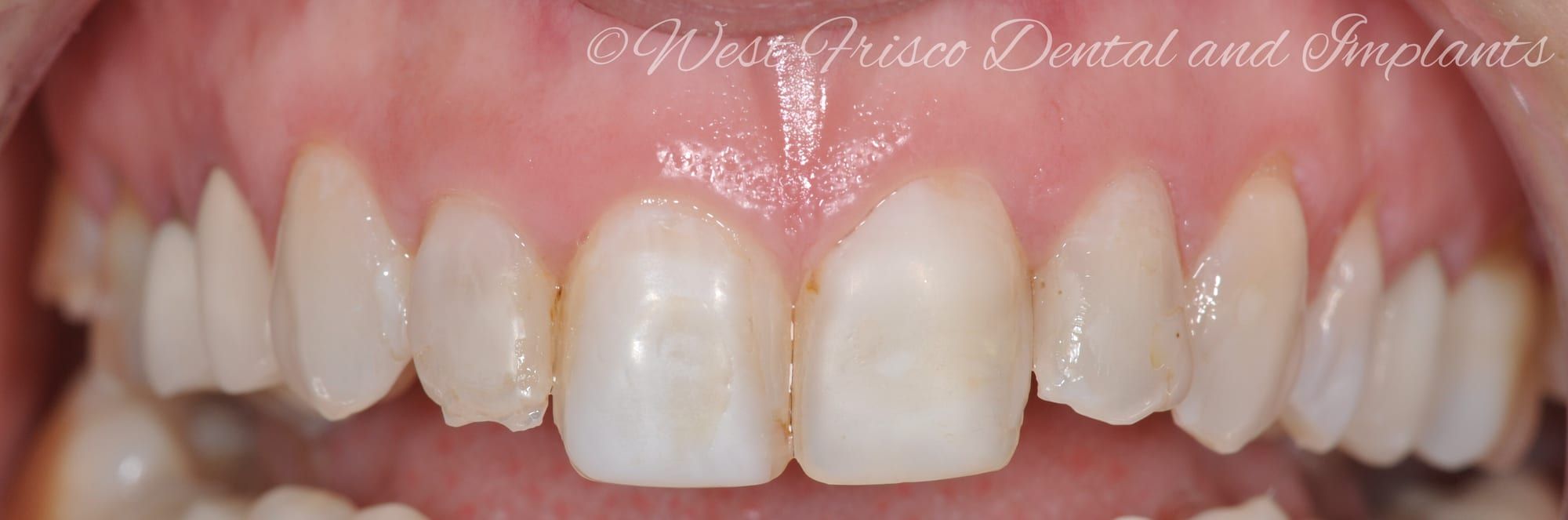 Porcelain veneers - before
