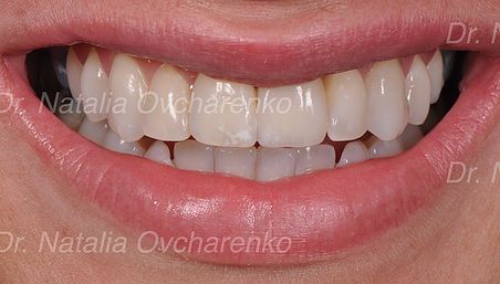 Dental implants - after
