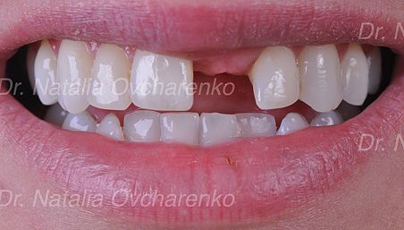 Dental implants - before