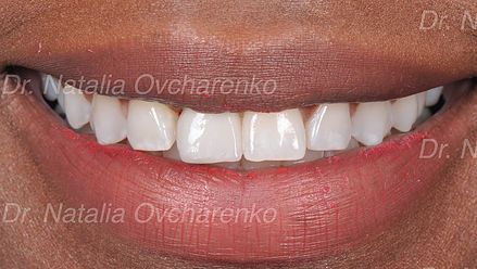 Dental implants - after