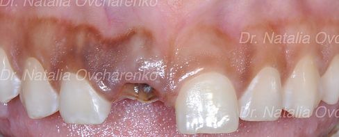 Dental implants - before