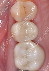 Dental implant case 3 - after