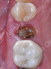 Dental implant case 3 - before