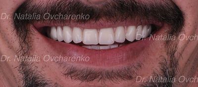 Dental implant case 4 - after
