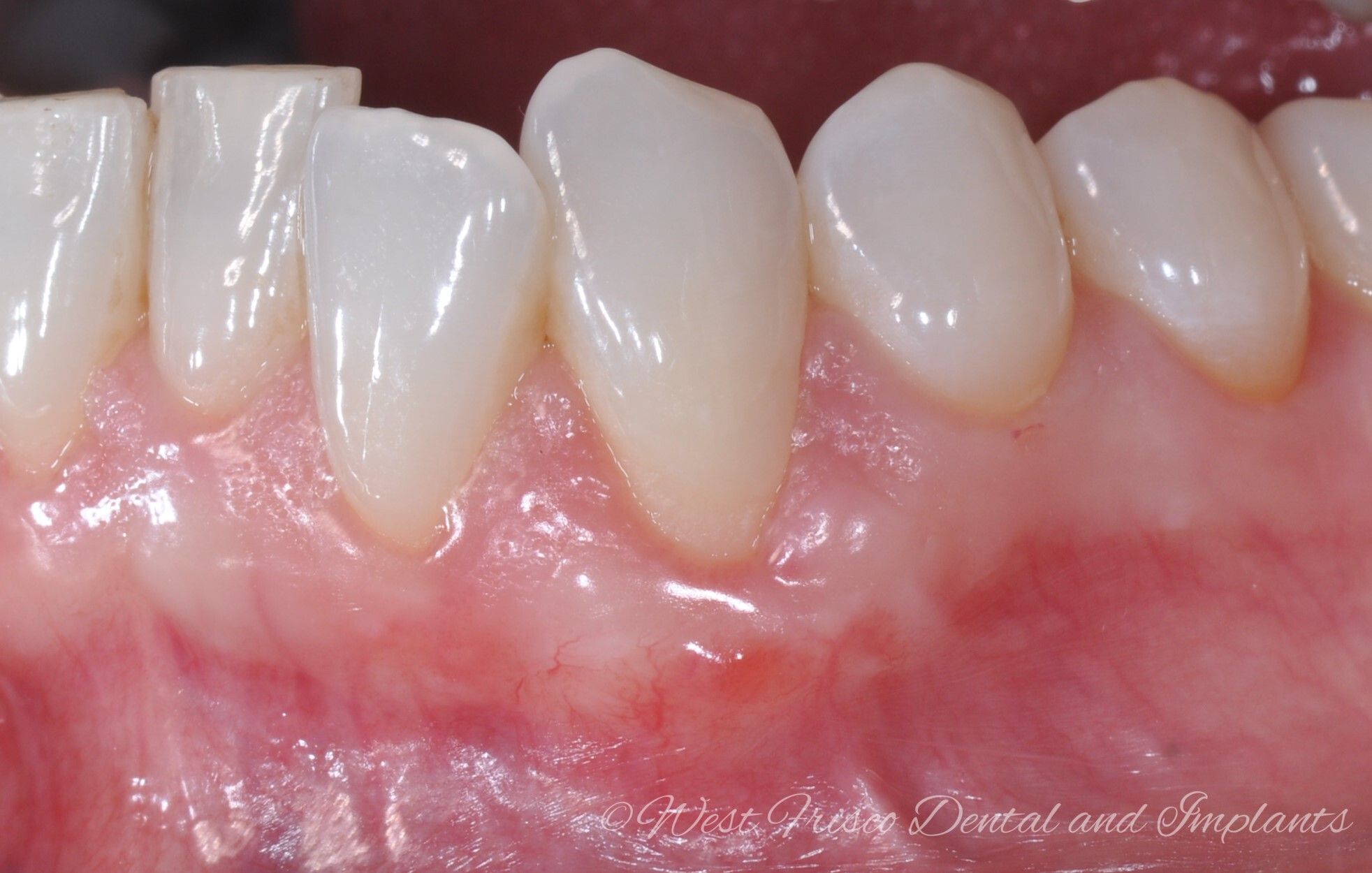 Gum grafting for recession - after
