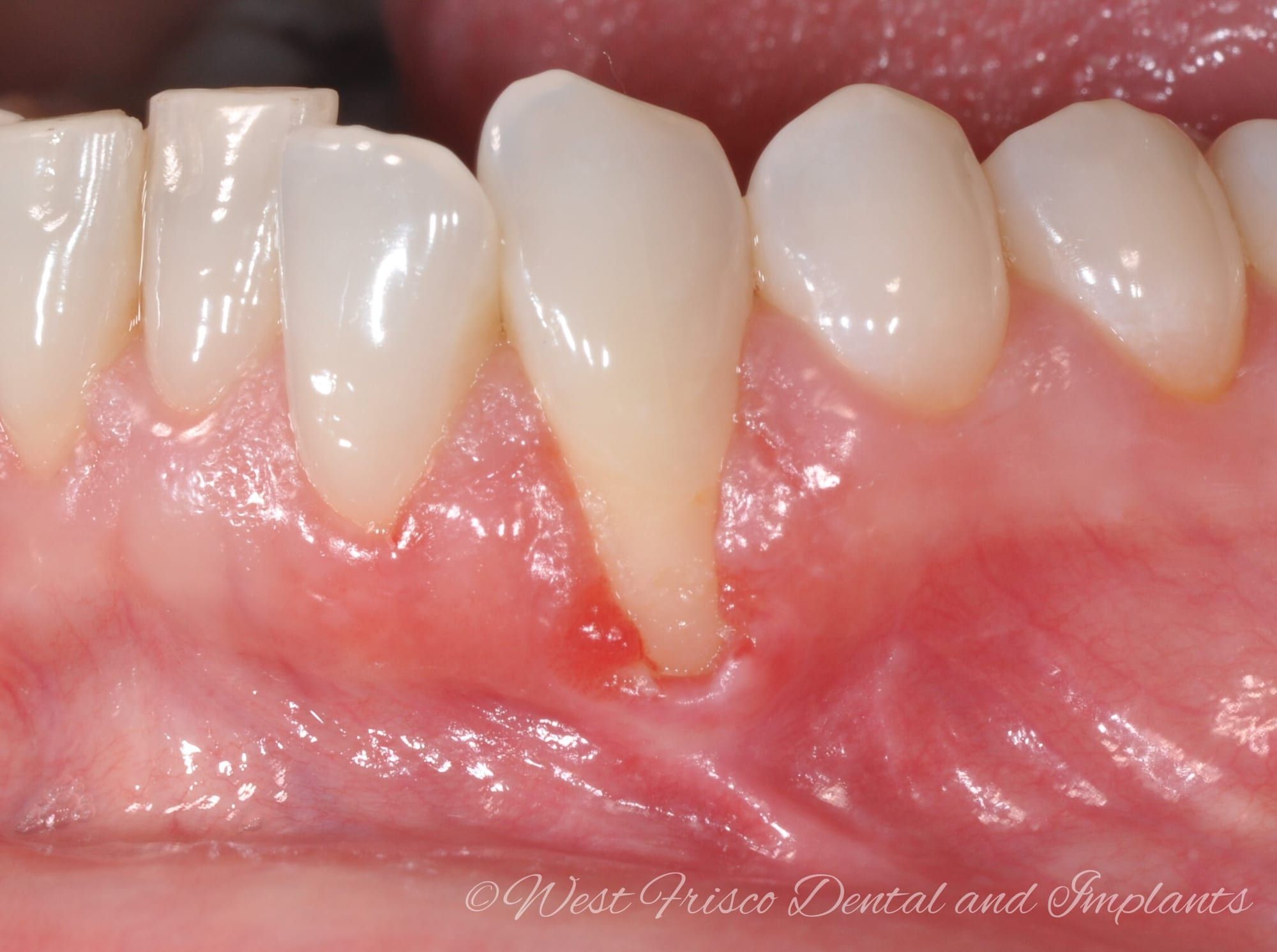 Gum grafting for recession - before