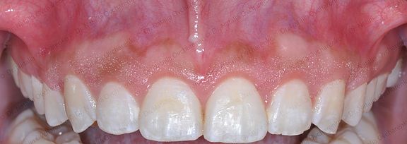 Gingivectomy case 2 - after