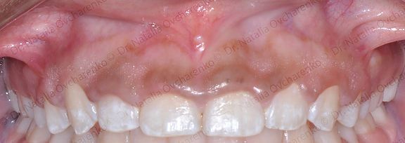 Gingivectomy case 2 - before