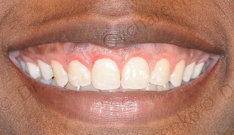 Gingivectomy case 1 - after