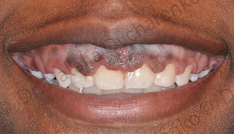 Gingivectomy case 1 - before