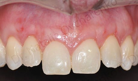 Gum grafting close-up - after