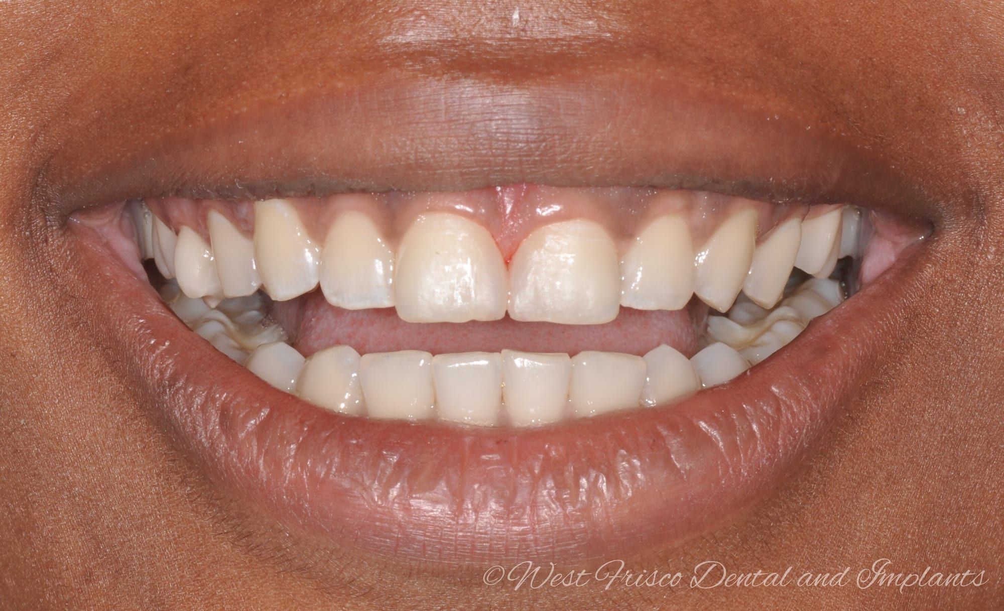 Dental bonding close-up - after