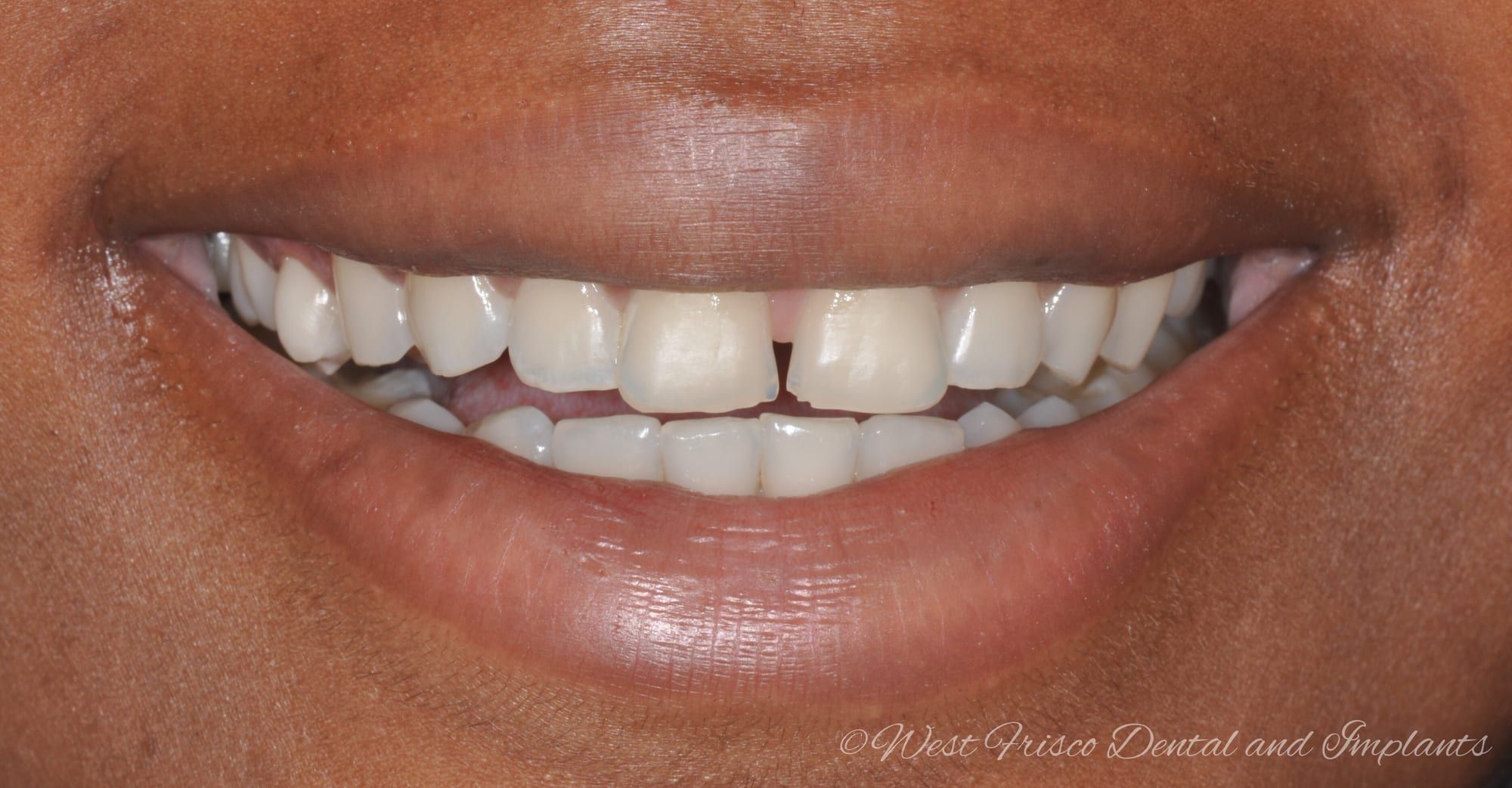 Dental bonding close-up - before