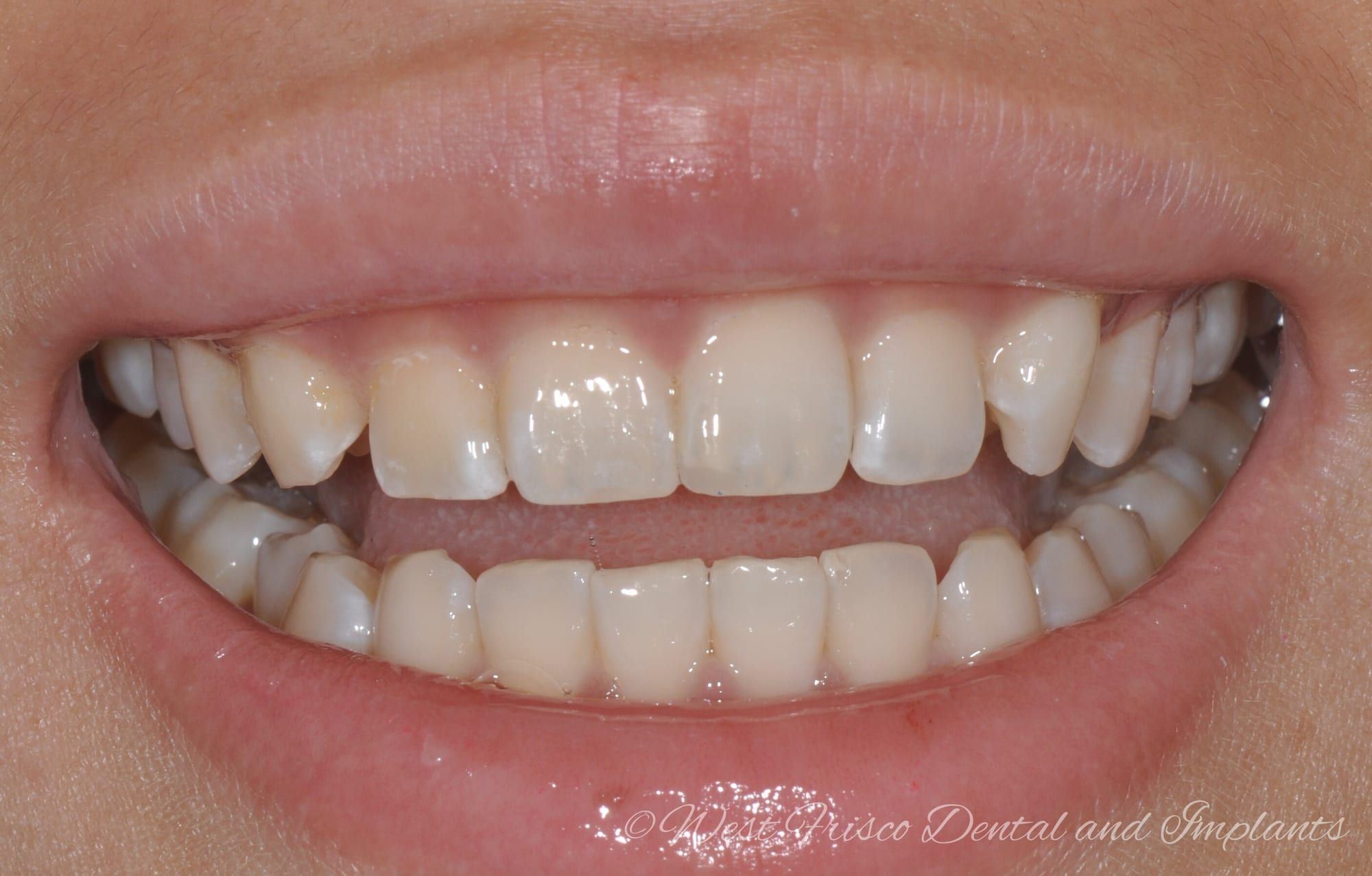 Dental bonding smile - after