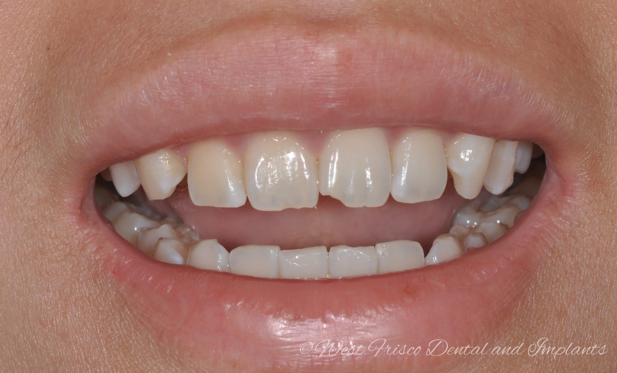 Dental bonding smile - before