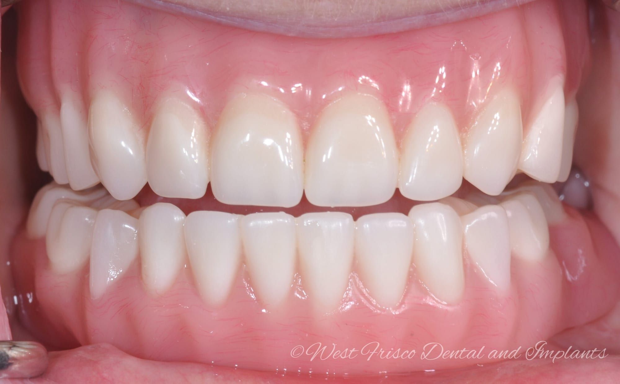 Implant dentures close-up - after