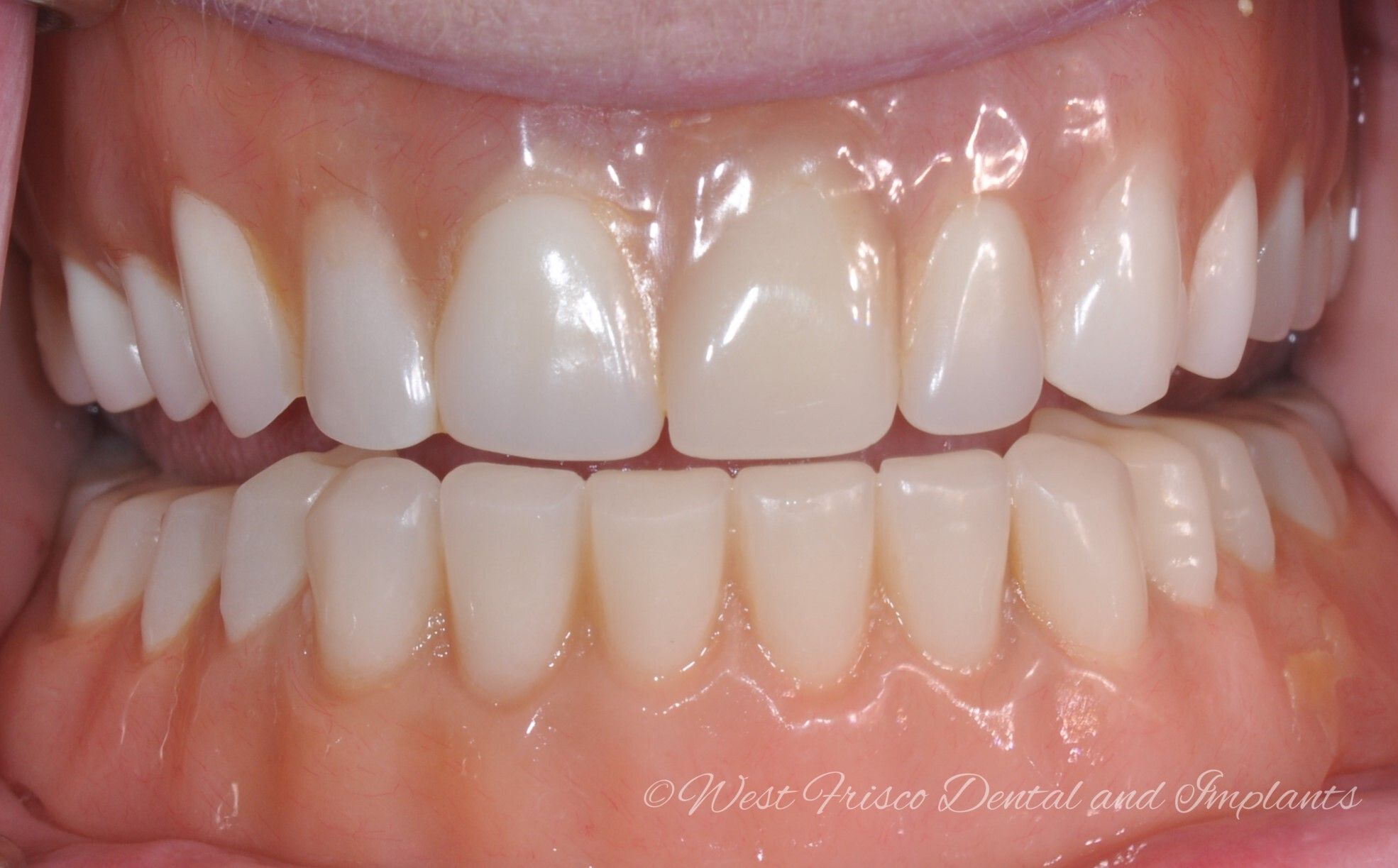 Implant dentures close-up - before