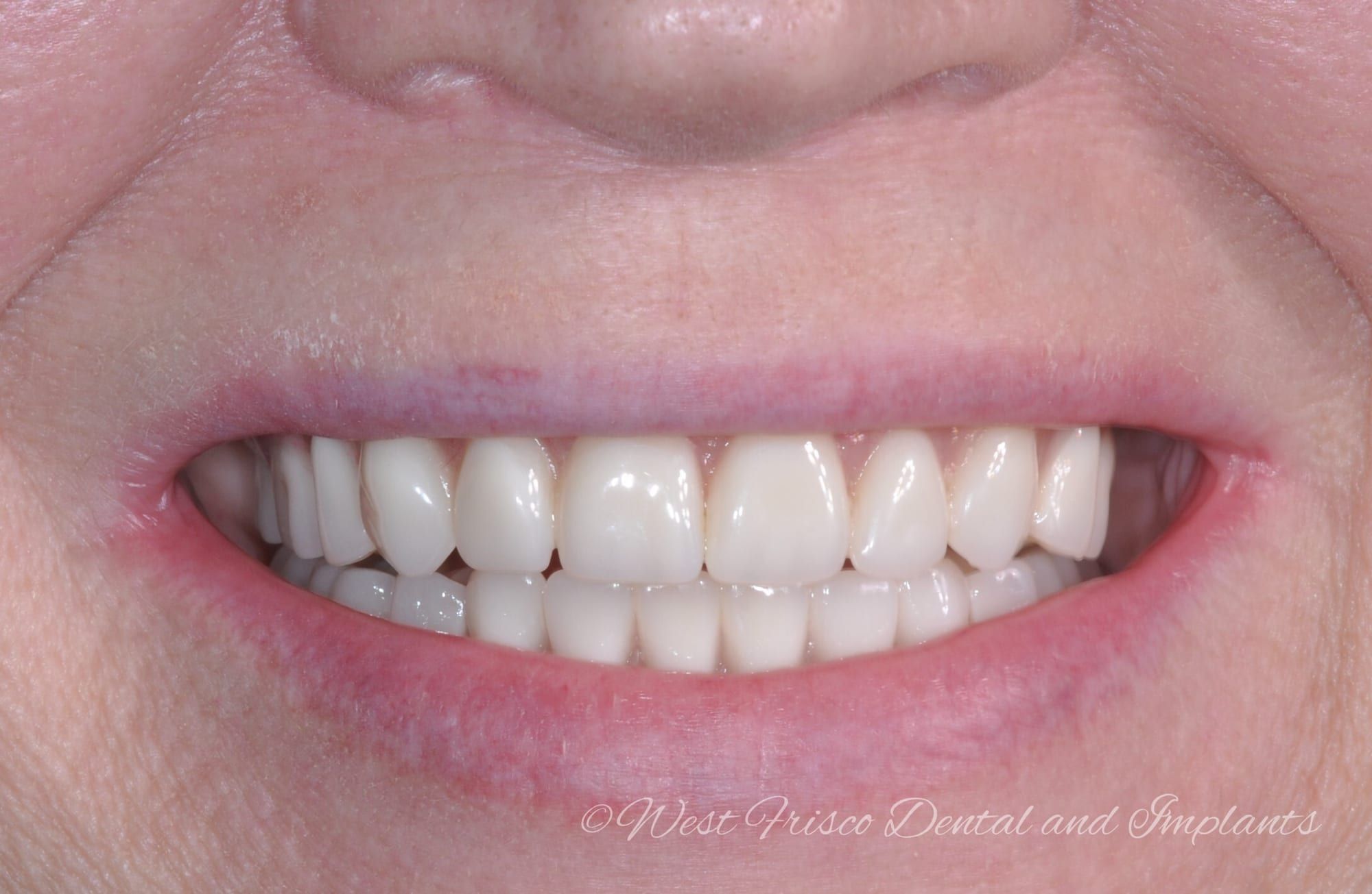 Implant denture smile - after