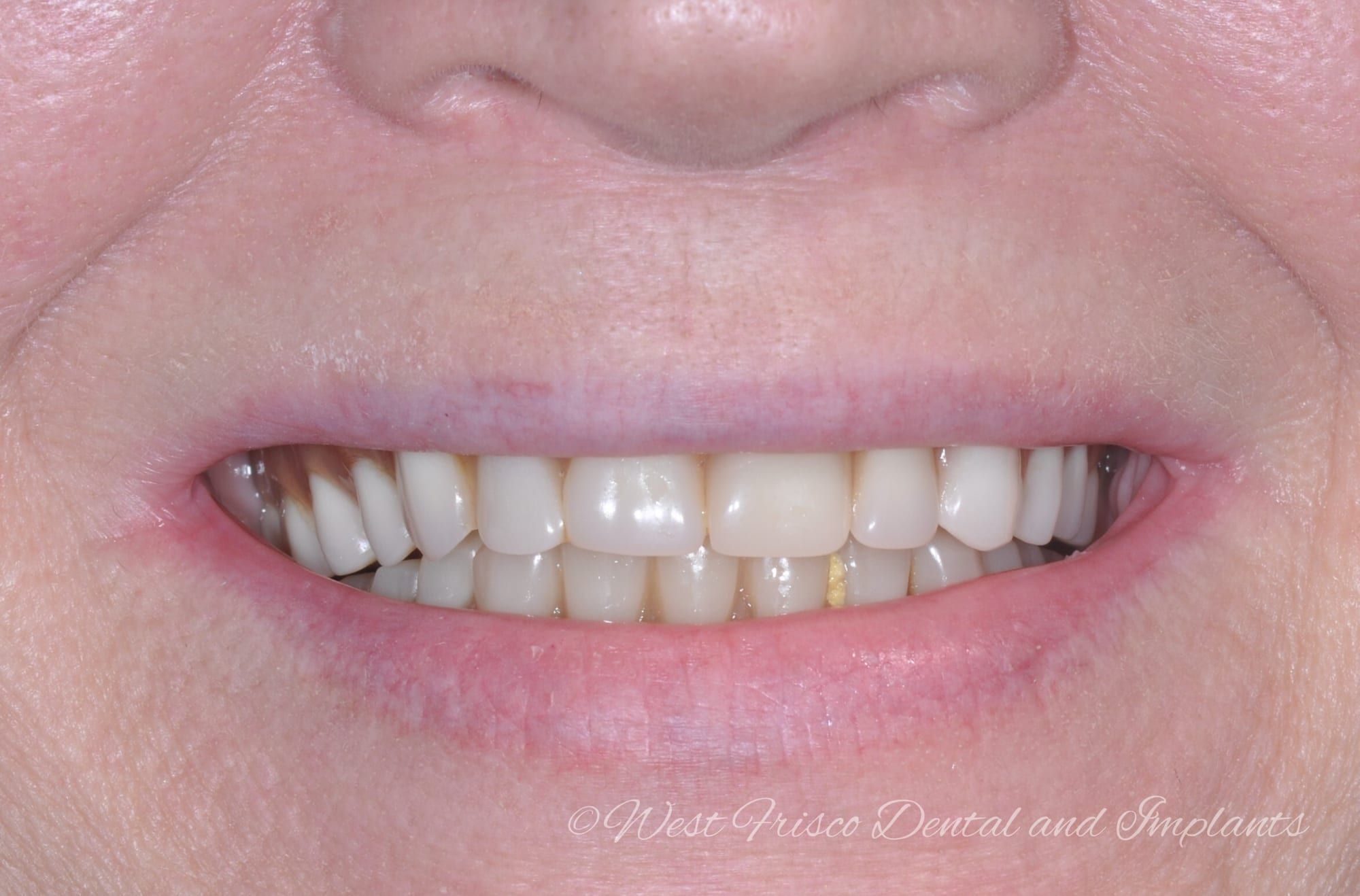 Implant denture smile - before