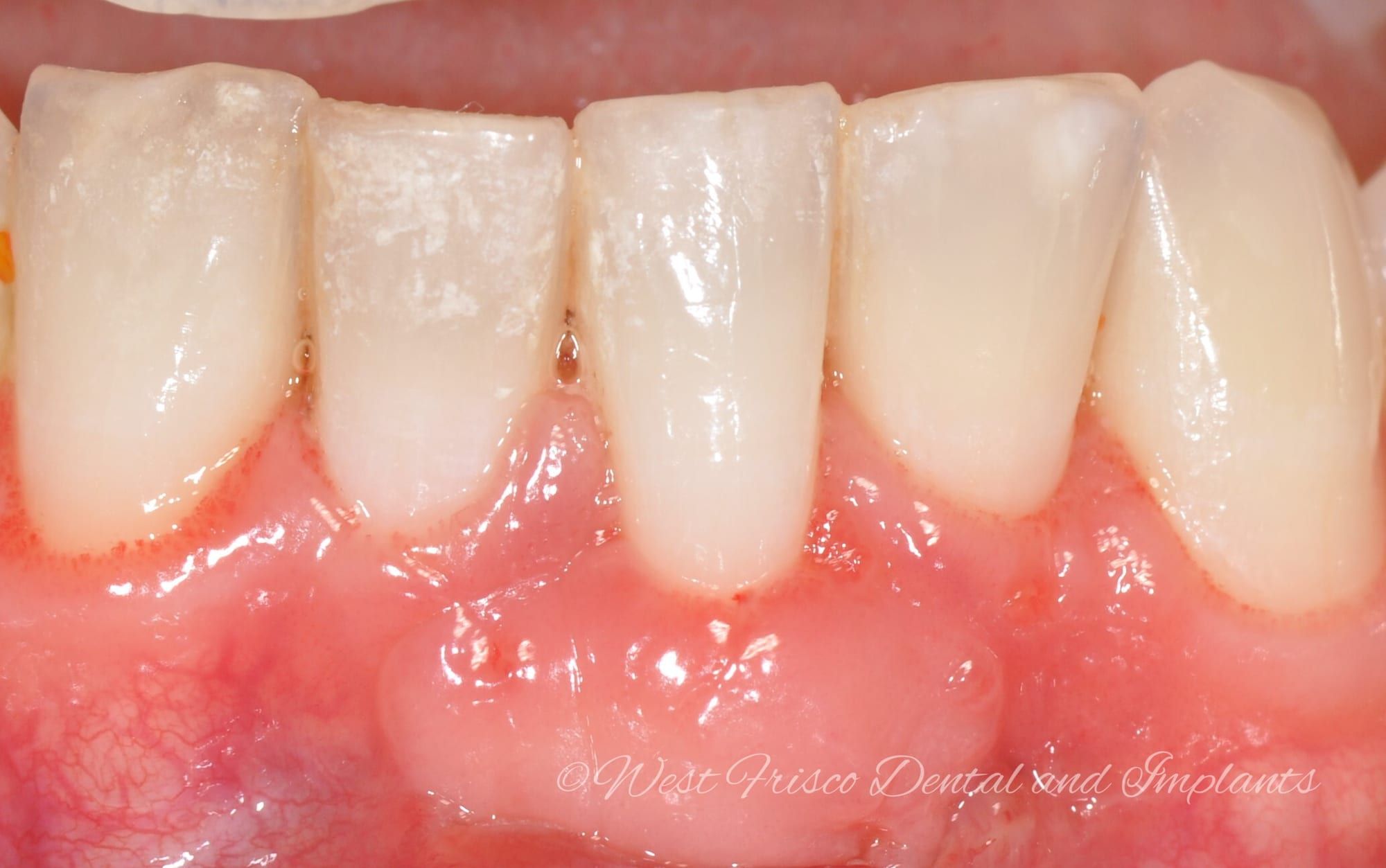 Gum graft for recession - after